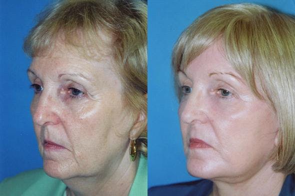 Facelift Before & After Gallery - Patient 122405763 - Image 2