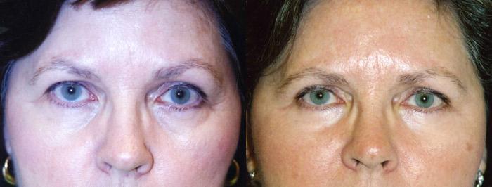 Eyelid Surgery Before & After Gallery - Patient 355122 - Image 1