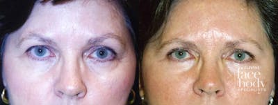 Eyelid Surgery Before & After Gallery - Patient 355122 - Image 1
