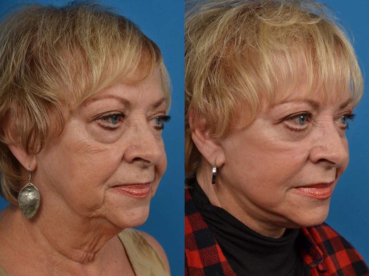 Dermal Fillers Before & After Gallery - Patient 122405775 - Image 2