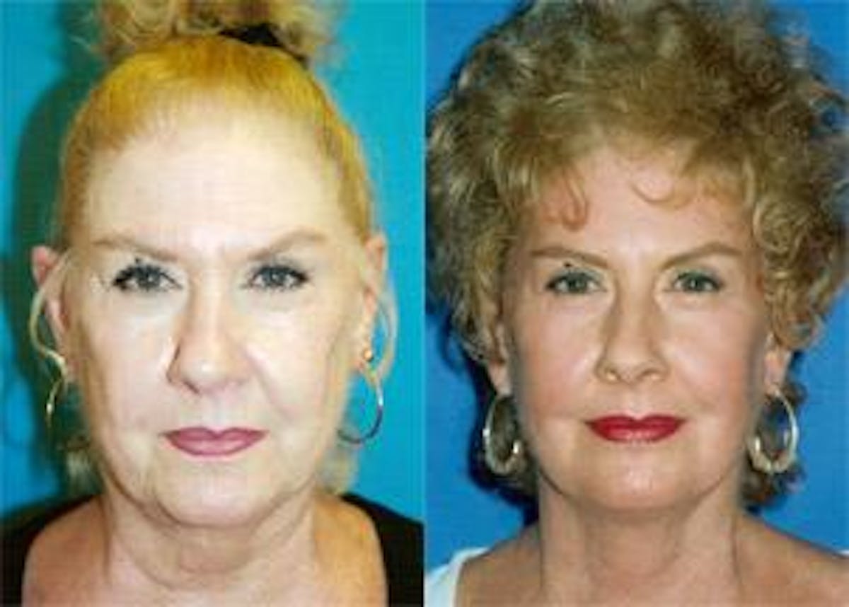 Facelift Before & After Gallery - Patient 122405766 - Image 1