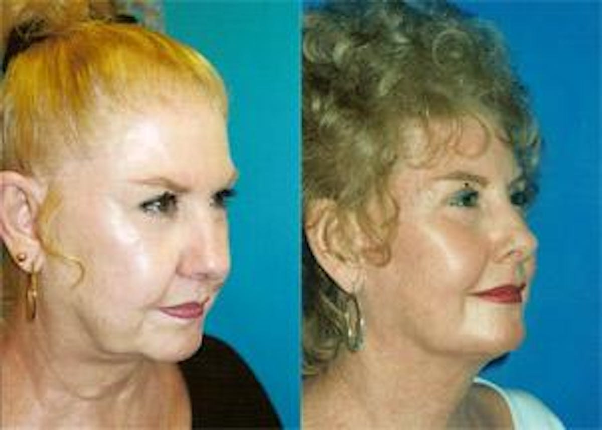 Facelift Before & After Gallery - Patient 122405766 - Image 2