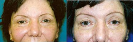 Eyelid Surgery Before & After Gallery - Patient 355655 - Image 1
