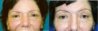 Eyelid Surgery Before & After Gallery - Patient 122405765 - Image 1