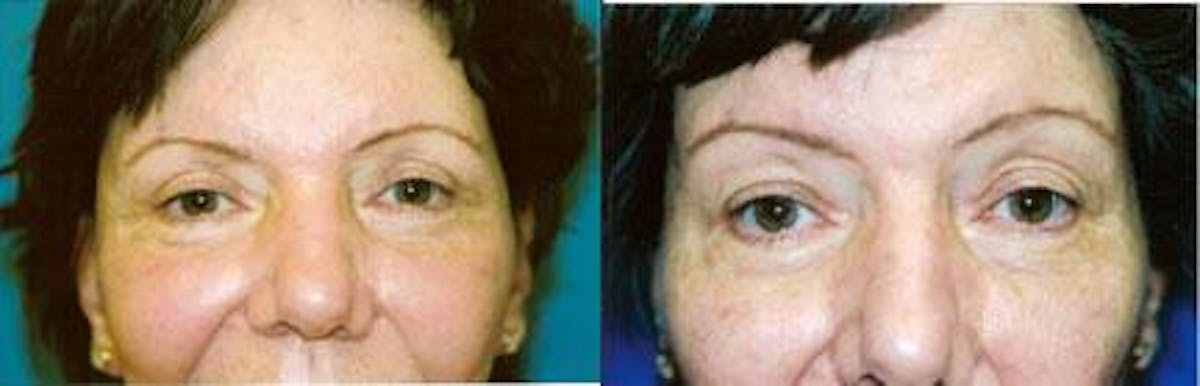Eyelid Surgery Before & After Gallery - Patient 122405765 - Image 1