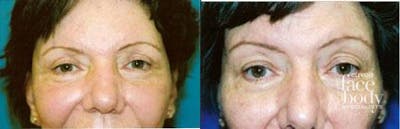 Eyelid Surgery Before & After Gallery - Patient 355655 - Image 1
