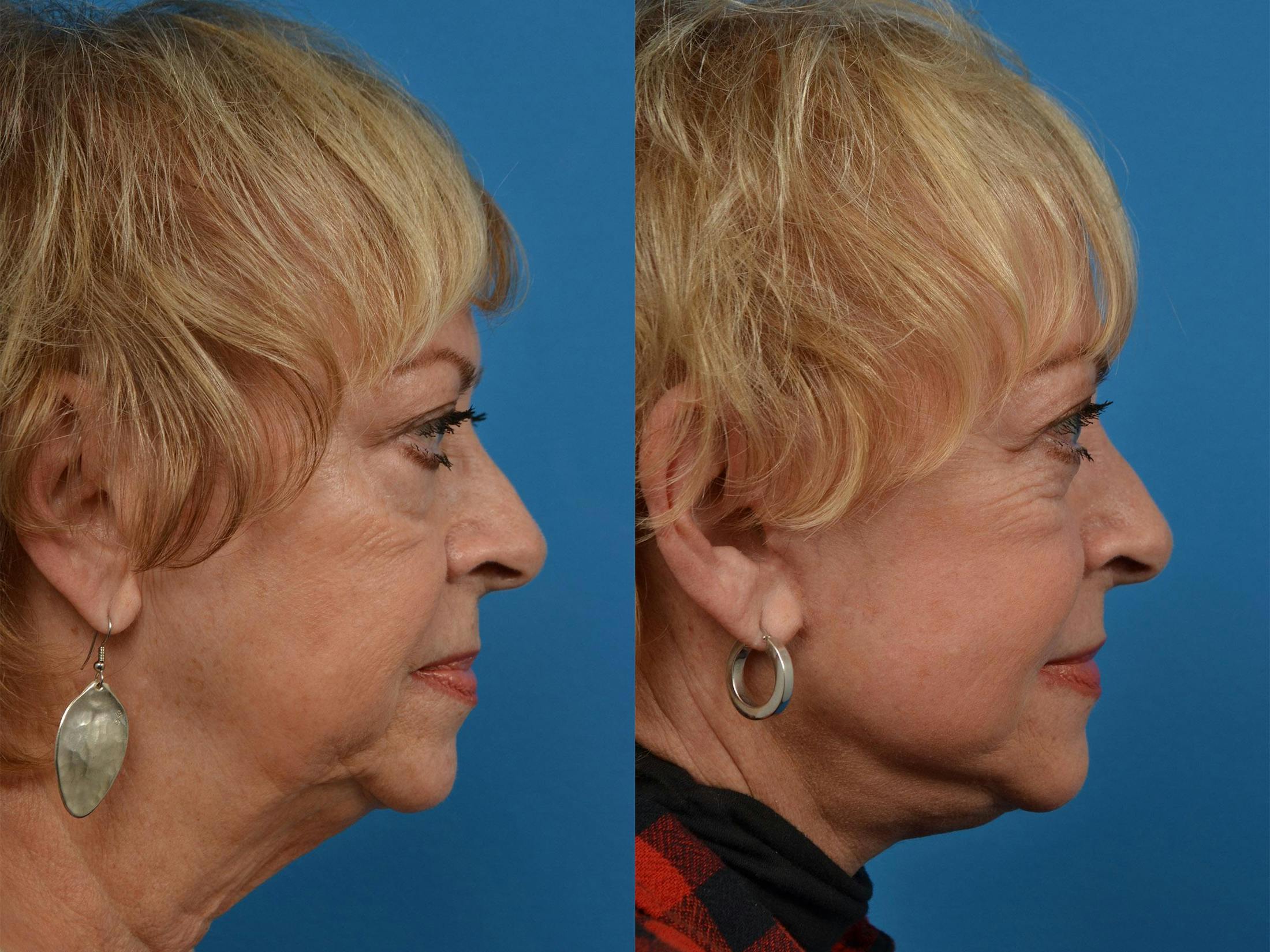 Dermal Fillers Before & After Gallery - Patient 122405775 - Image 3