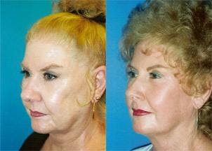 Facelift Before & After Gallery - Patient 122405766 - Image 3