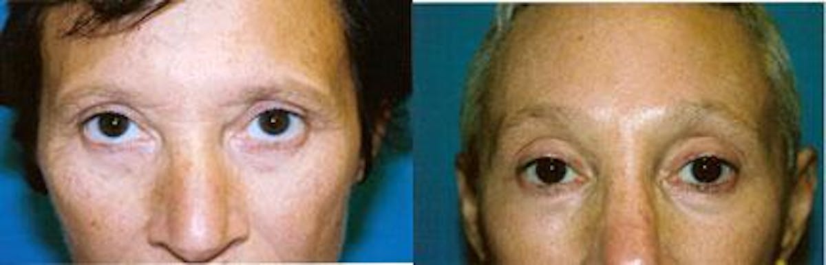 Eyelid Surgery Before & After Gallery - Patient 122405767 - Image 1