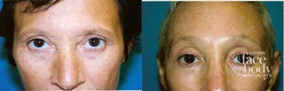 Eyelid Surgery Before & After Gallery - Patient 343046 - Image 1