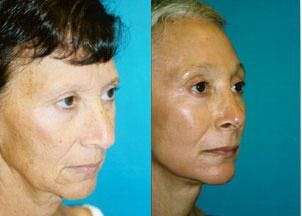 Facelift Before & After Gallery - Patient 122405768 - Image 1