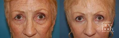 Eyelid Surgery Before & After Gallery - Patient 127890 - Image 1