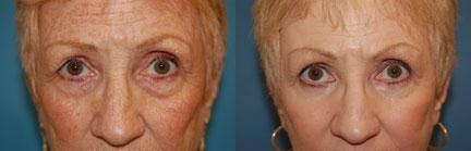 Eyelid Surgery Before & After Gallery - Patient 122405769 - Image 1