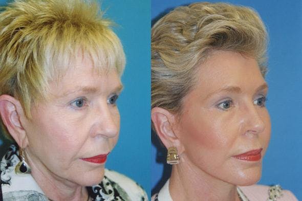 Facelift Before & After Gallery - Patient 122405770 - Image 1