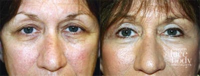 Eyelid Surgery Before & After Gallery - Patient 540859 - Image 1
