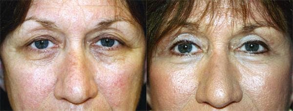 Eyelid Surgery Before & After Gallery - Patient 122405771 - Image 1