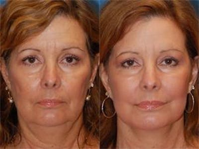 Facelift Before & After Gallery - Patient 122405772 - Image 1