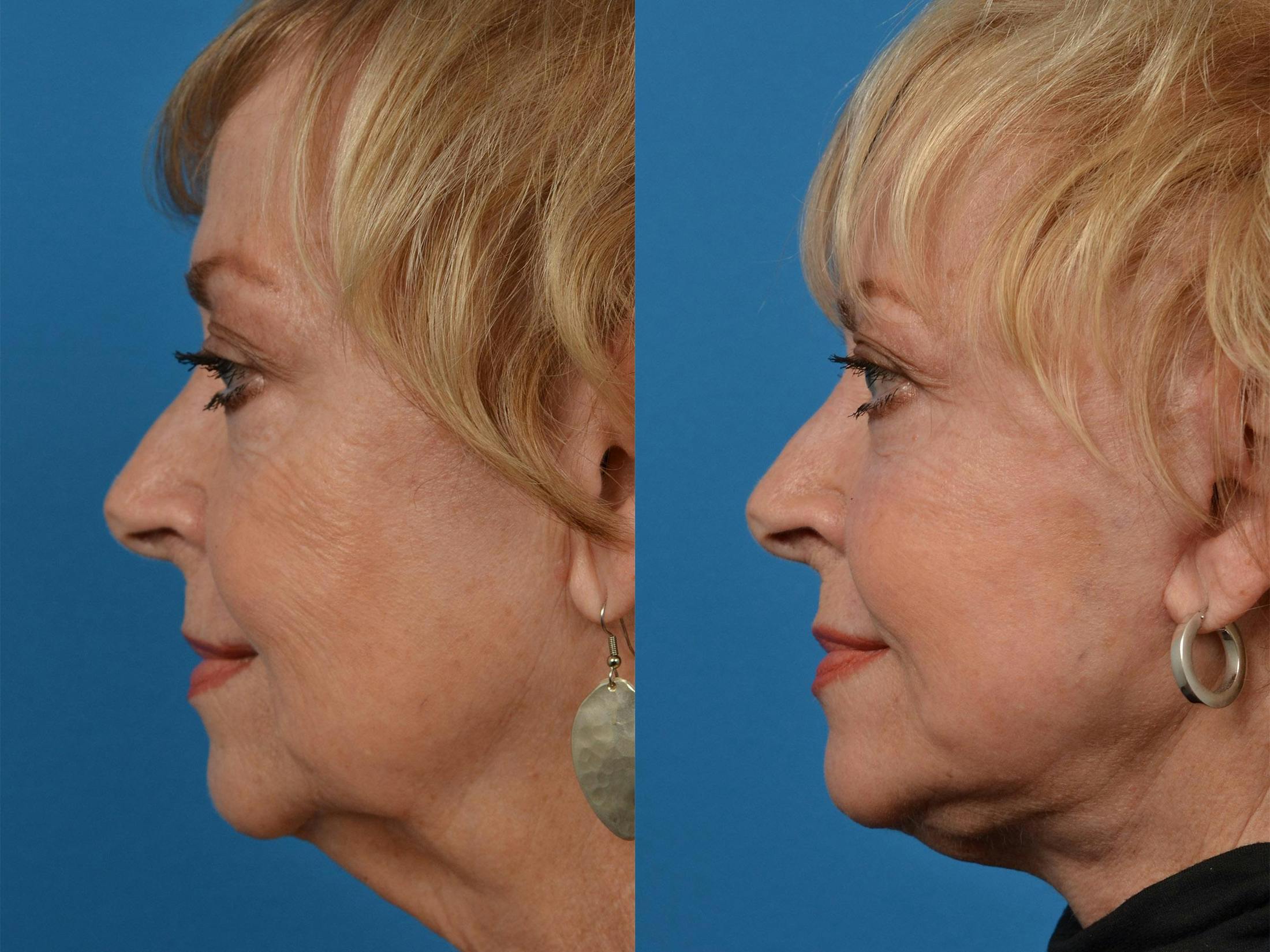 Dermal Fillers Before & After Gallery - Patient 122405775 - Image 5