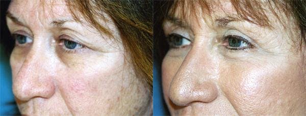 Eyelid Surgery Before & After Gallery - Patient 122405771 - Image 2