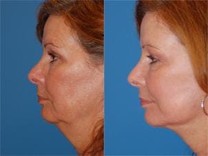 Facelift Before & After Gallery - Patient 122405772 - Image 2
