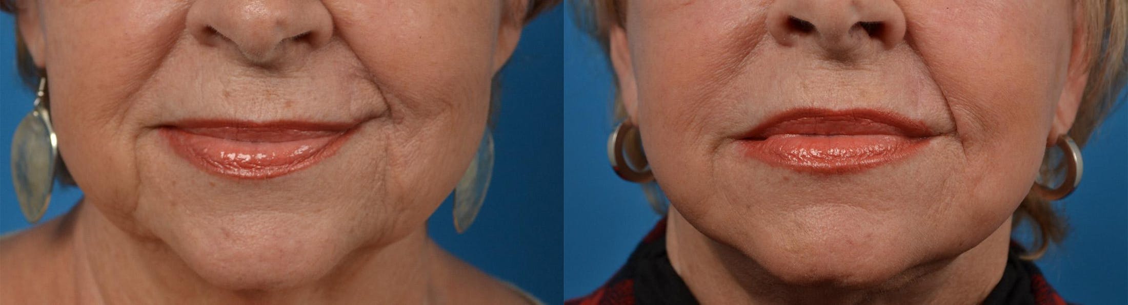 Dermal Fillers Before & After Gallery - Patient 122405775 - Image 6