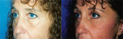 Eyelid Surgery Before & After Gallery - Patient 331696 - Image 1