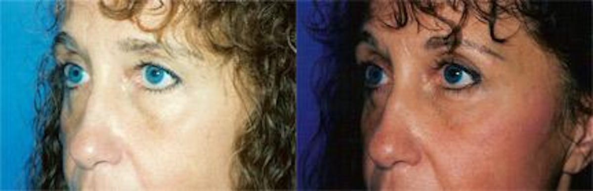 Eyelid Surgery Before & After Gallery - Patient 122405773 - Image 1