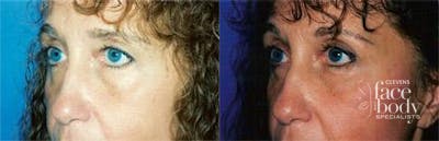 Eyelid Surgery Before & After Gallery - Patient 331696 - Image 1