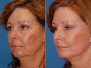 Facelift Before & After Gallery - Patient 122405772 - Image 3