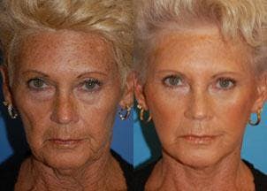 Facelift Before & After Gallery - Patient 122405777 - Image 1