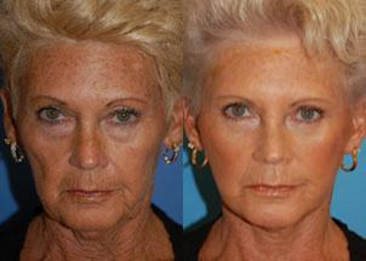 Facelift Before & After Gallery - Patient 122405777 - Image 1