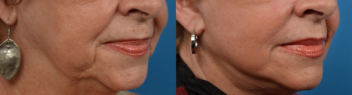 Dermal Fillers Before & After Gallery - Patient 122405775 - Image 7