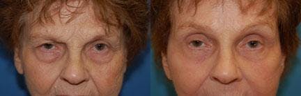 Eyelid Surgery Before & After Gallery - Patient 122405774 - Image 1