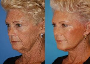Facelift Before & After Gallery - Patient 122405777 - Image 2