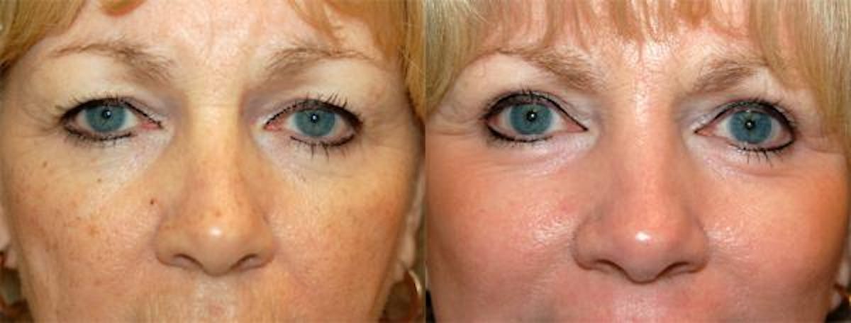 Eyelid Surgery Before & After Gallery - Patient 122405776 - Image 1