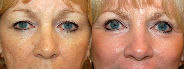 Eyelid Surgery Before & After Gallery - Patient 122405776 - Image 1