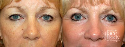 Eyelid Surgery Before & After Gallery - Patient 312864 - Image 1