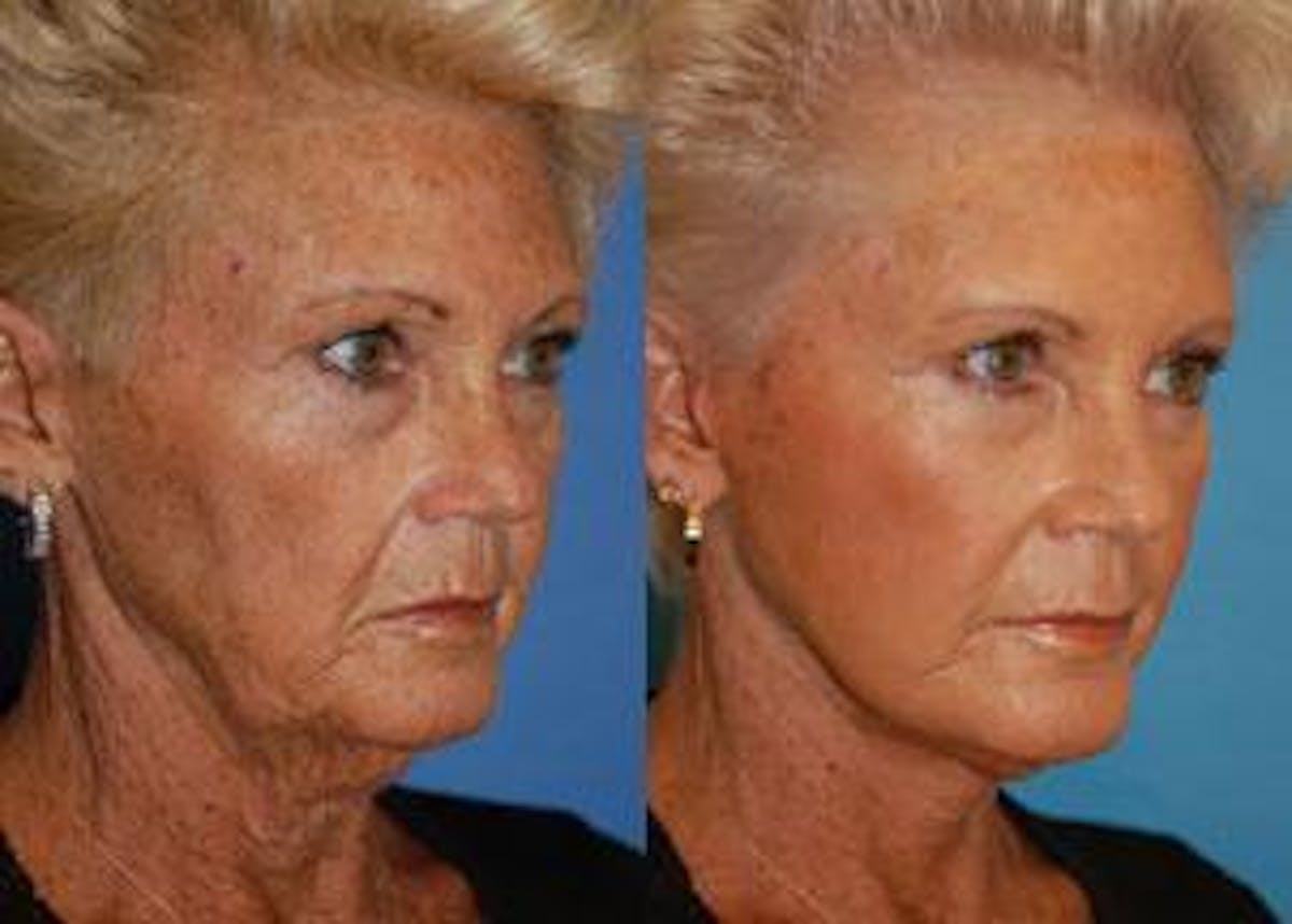 Facelift Before & After Gallery - Patient 122405777 - Image 3
