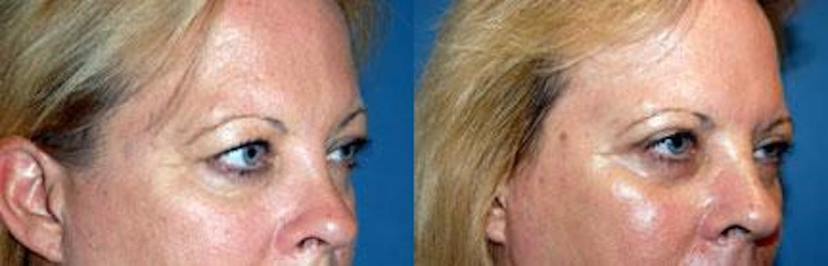 Eyelid Surgery Before & After Gallery - Patient 122405778 - Image 1