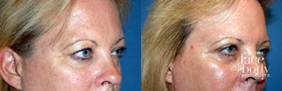 Eyelid Surgery Before & After Gallery - Patient 384920 - Image 1