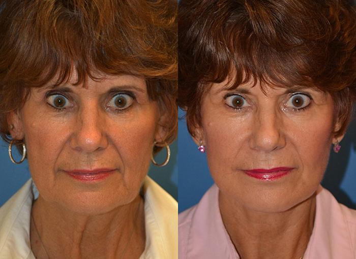 Facelift Before & After Gallery - Patient 122405780 - Image 1