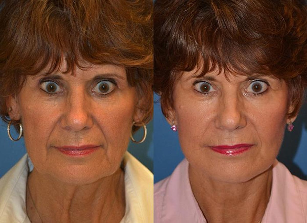 Facelift Before & After Gallery - Patient 122405780 - Image 1