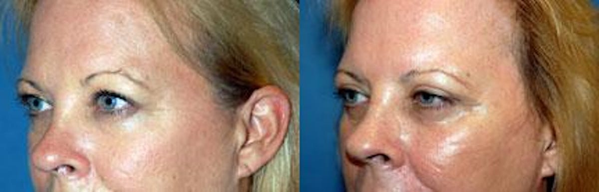 Eyelid Surgery Before & After Gallery - Patient 122405778 - Image 2