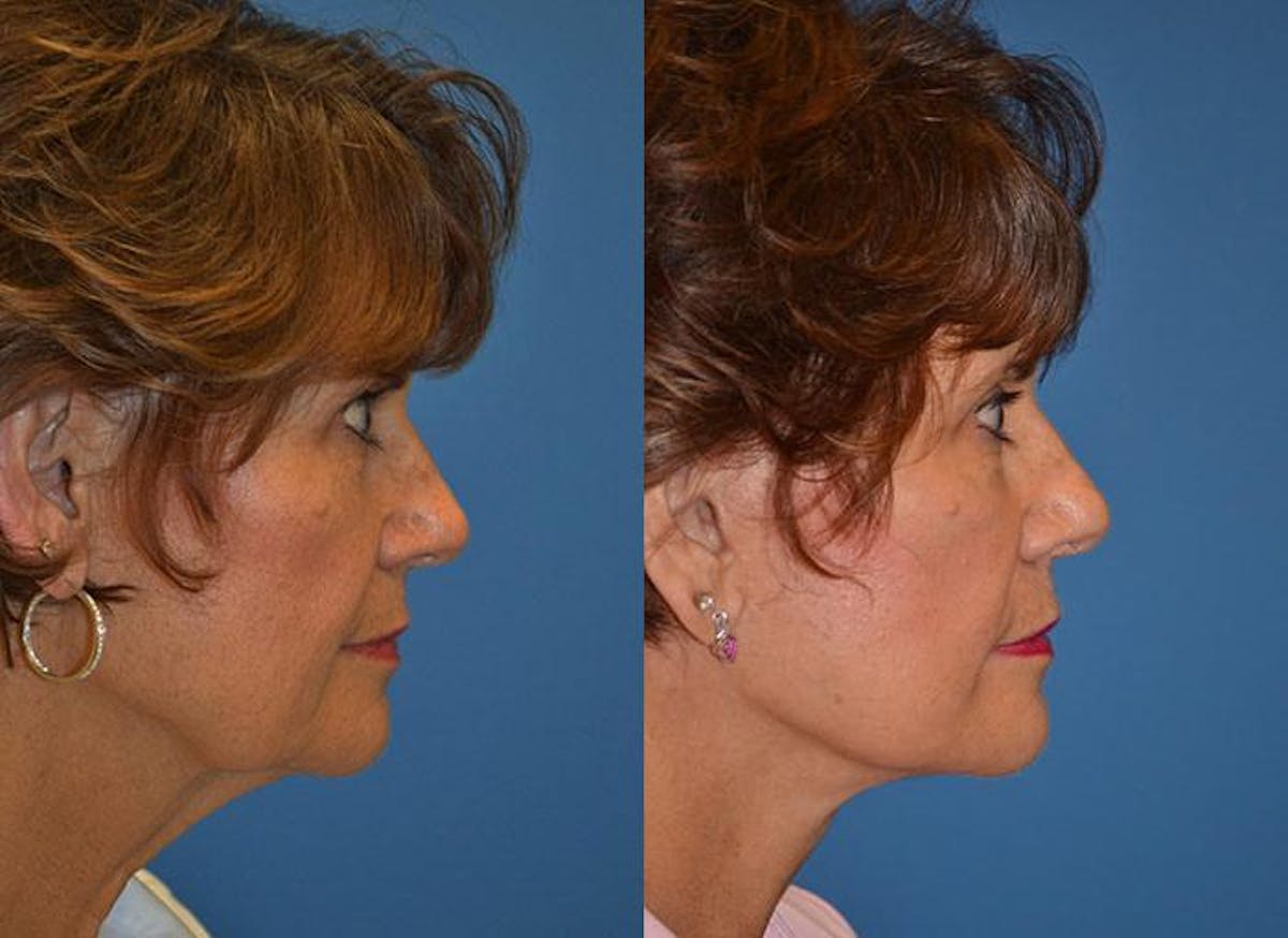 Facelift Before & After Gallery - Patient 122405780 - Image 2