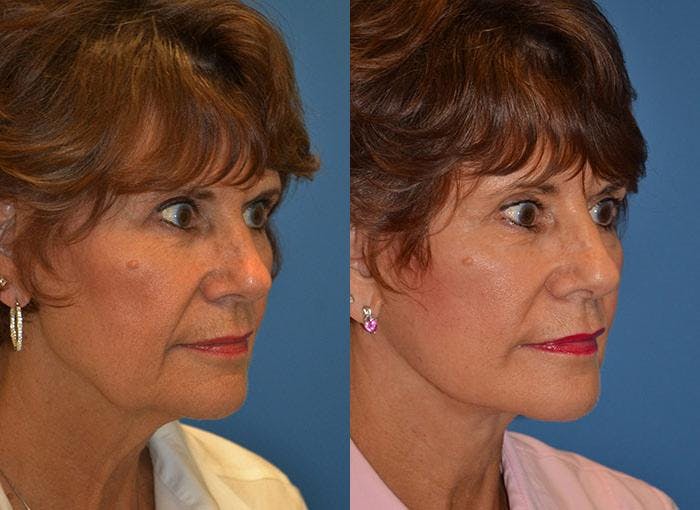 Facelift Before & After Gallery - Patient 122405780 - Image 3