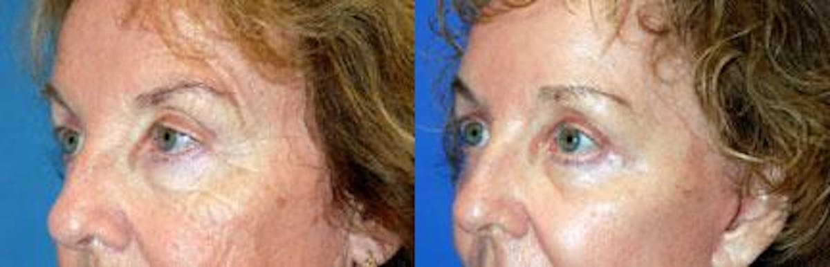 Eyelid Surgery Before & After Gallery - Patient 122405779 - Image 1