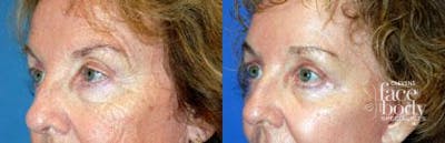 Eyelid Surgery Before & After Gallery - Patient 236584 - Image 1