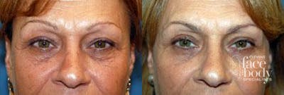 Eyelid Surgery Before & After Gallery - Patient 105740 - Image 1
