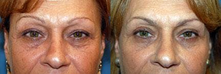 Eyelid Surgery Before & After Gallery - Patient 122405781 - Image 1