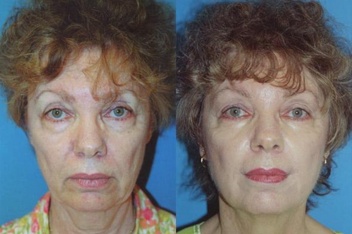 Facelift Before & After Gallery - Patient 122405782 - Image 1